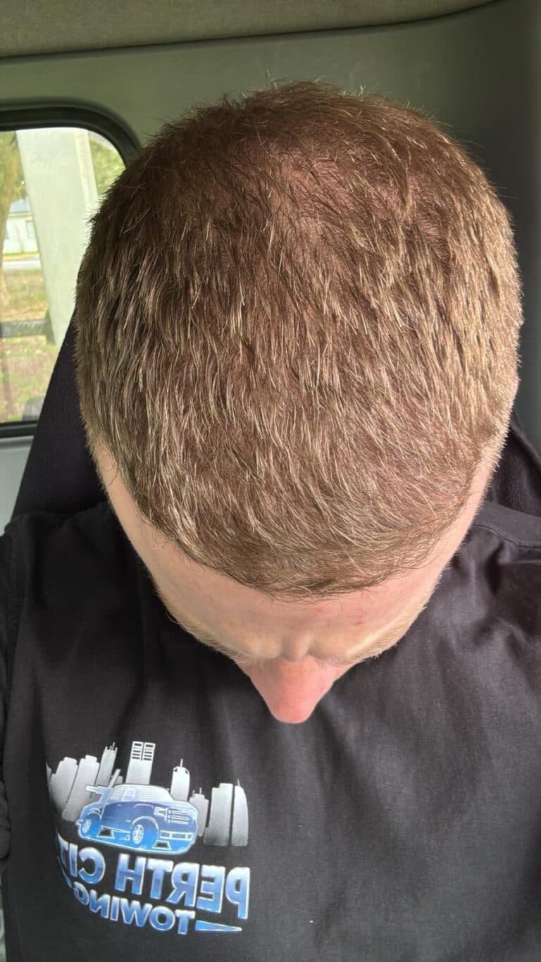 Hairline Redesign after