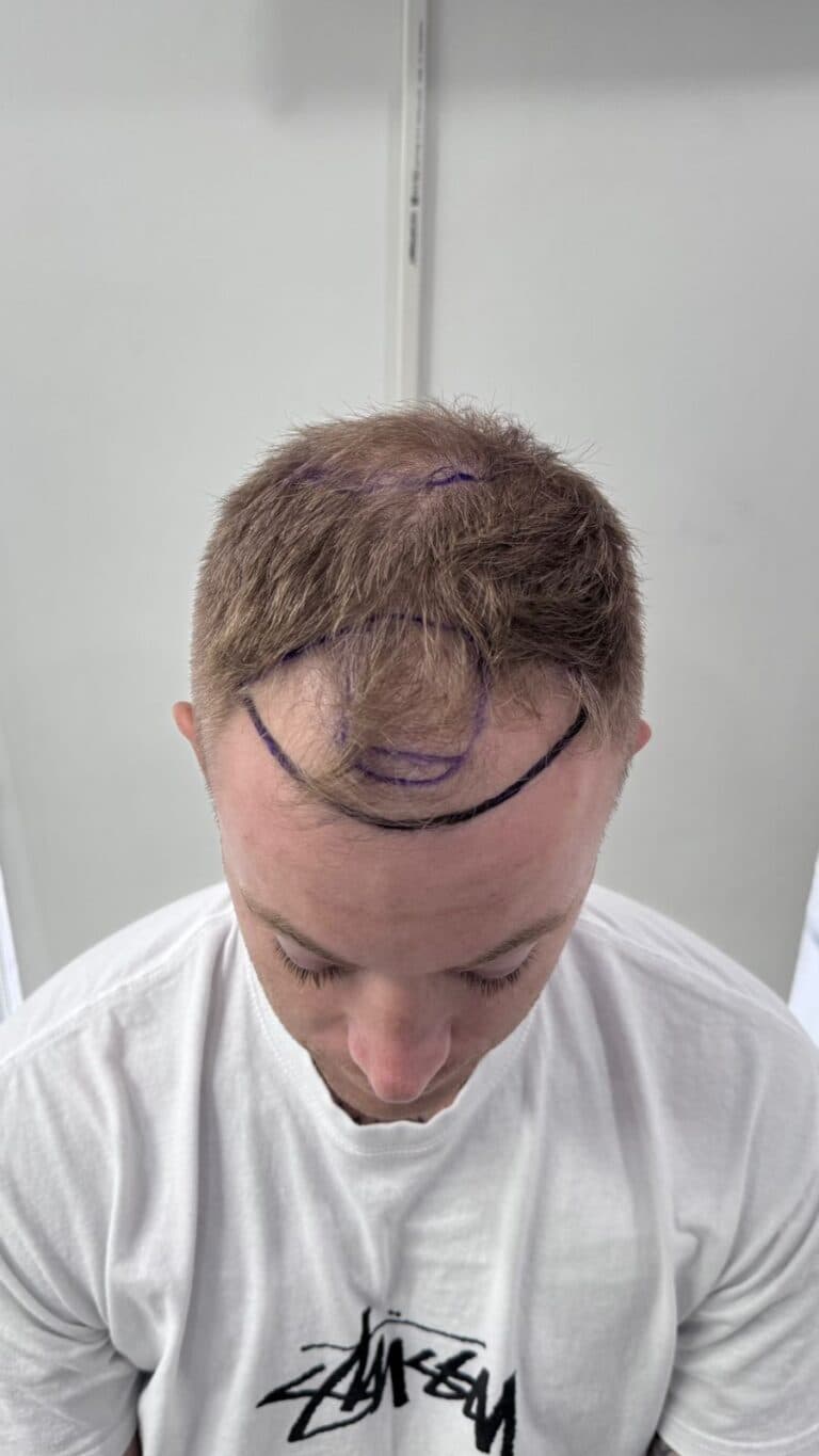 Hairline Redesign - before
