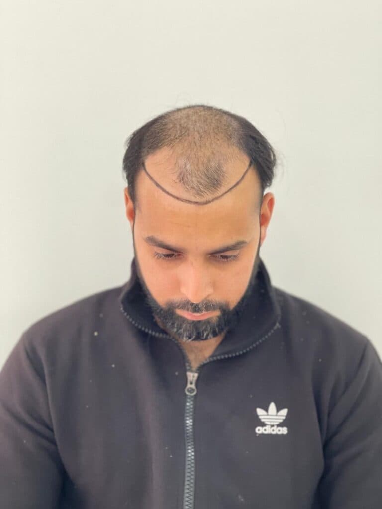 FUE Sapphire - before