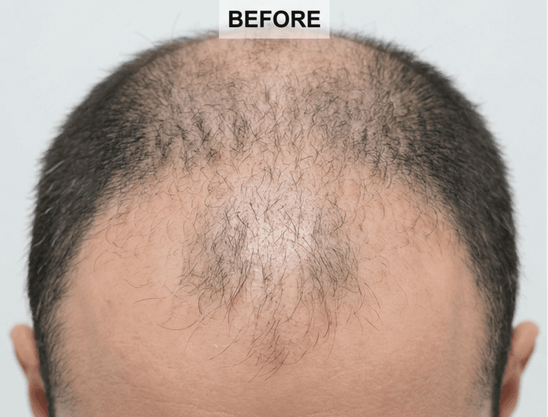 FUE Sapphire - before